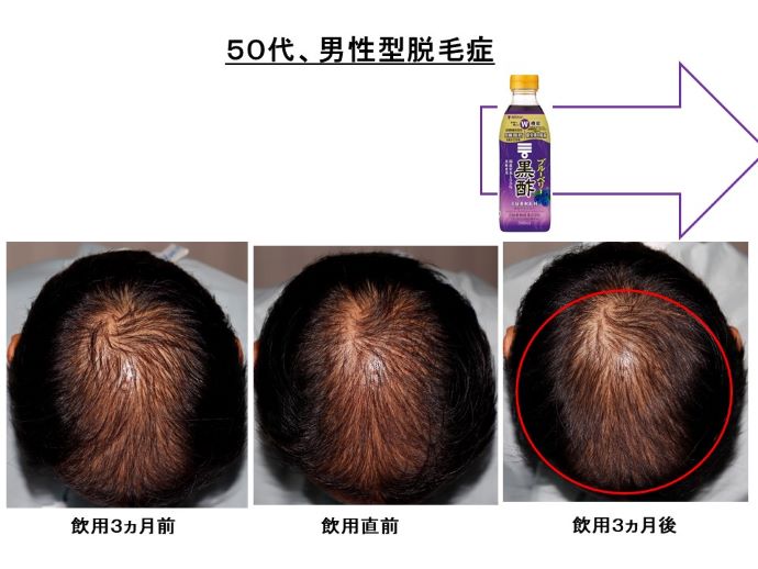円形脱毛症　病院
